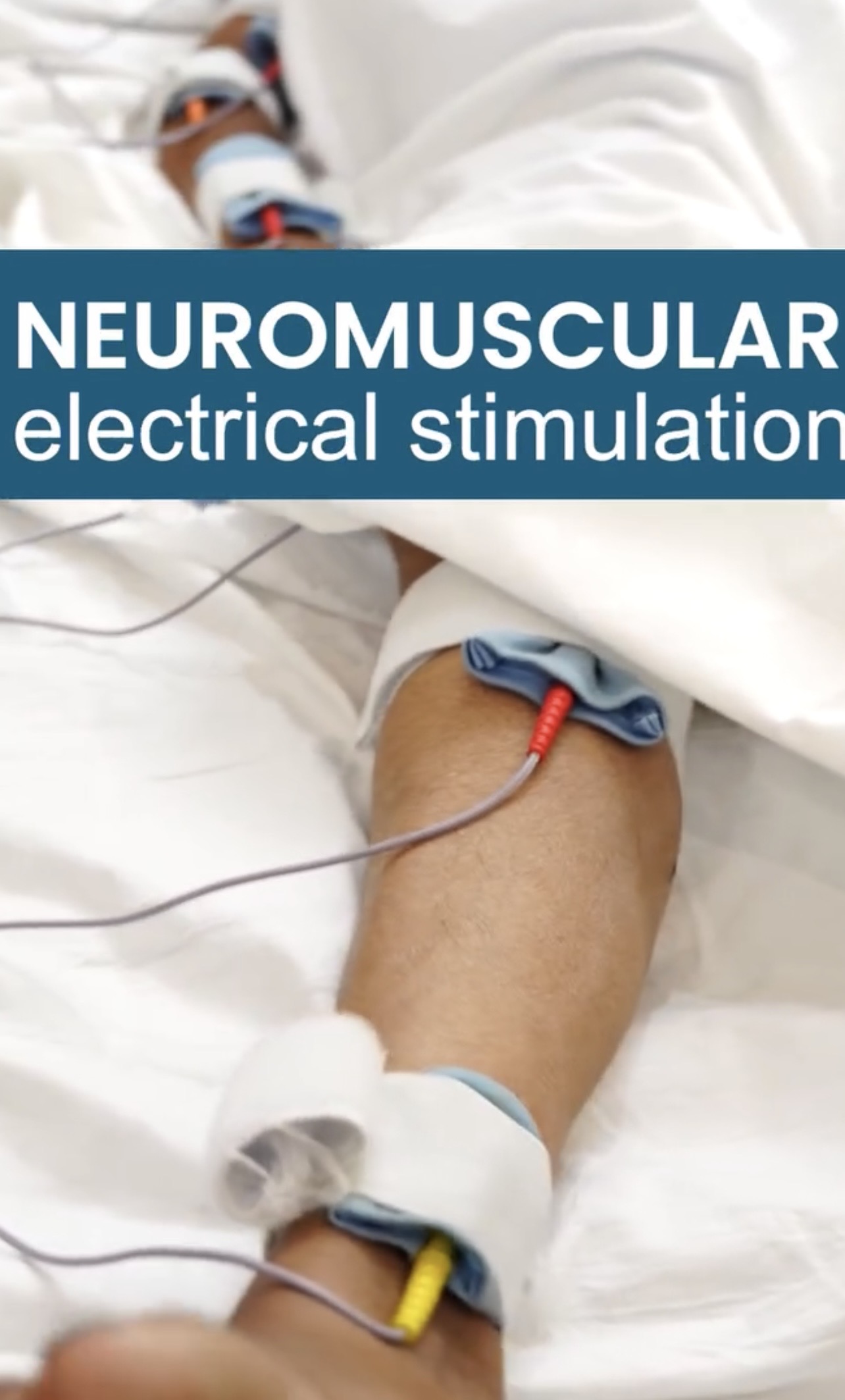 Hemiplegic arm upper limb rehabilitation after stroke SENSE Health